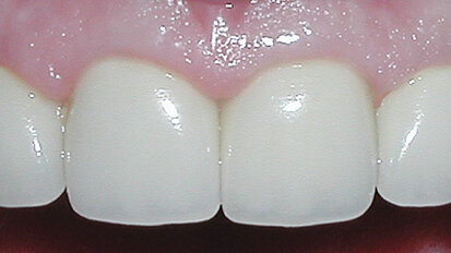 Clinical indications for a composite metal PFM restorative