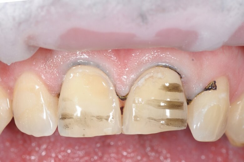 Fig. 3 To fit two lithium disilicate veneers, a preparation of 1 mm was required. After removing the mock-up, the preparation was perfected.