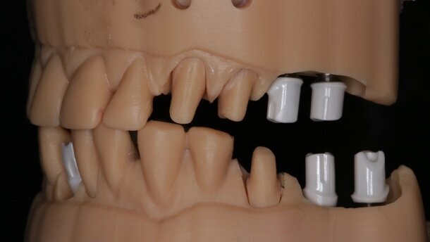 Indywidualne łączniki hybrydowe tytanowo-cyrkonowe – obserwacje 3-letnie