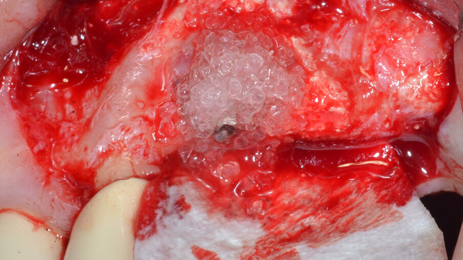 Fig. 9 - Membrana barriera stabilizzata mediante pins in titanio.