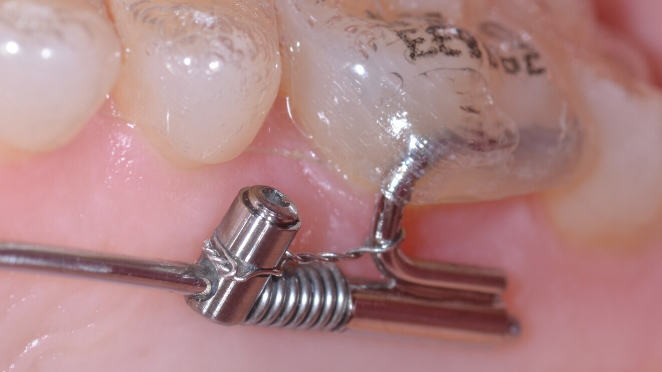 Fig. 4: Bonded tube for the connection from a Beneslider to a molar. After distalisation, the appliance should be left in situ for molar anchorage (made passive by using a steel ligature).