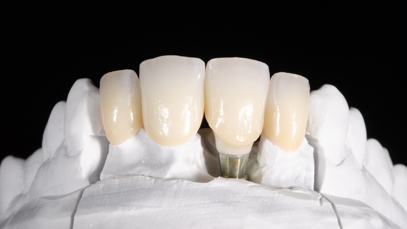 Fig. 2: Crowns milled from KATANA Zirconia YML with a facial cutback of 0.6 mm after individualisation with Esthetic Colorant, sintering, internal staining and the application of a first layer of porcelain. 