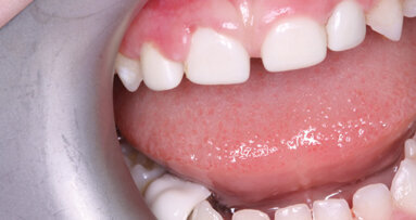 Shofu announces capsule delivery system for two of its products