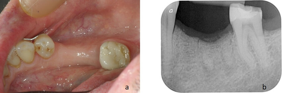 Fig. 5 - a: aspetto clinico del sito a 24 mesi dall’innesto, lo spessore crestale appare inalterato. b: radiografia endorale a 24 mesi. Anche l’altezza crestale appare conservata.