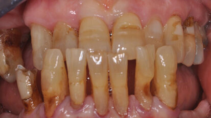Trattamento di una mandibola edentula atrofica mediante 4 impianti Tapered e protesi fissa avvitata