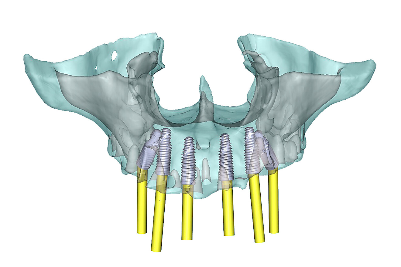 Fig. 3a: Selective transparency views of the simulated implants in the maxillary arch, including posterior tilted implants to avoid the maxillary sinus; frontal view.