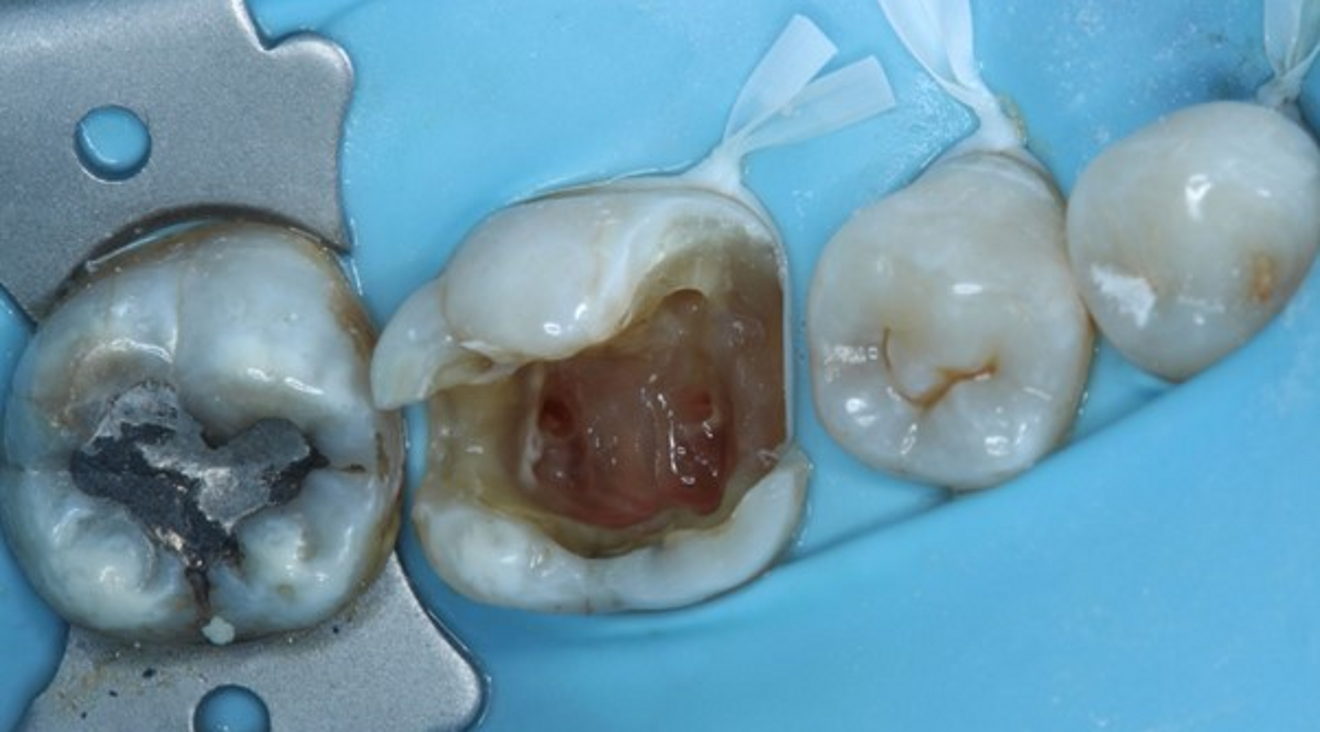 Fig. 3: After caries removal, showing the deep mesial margin.