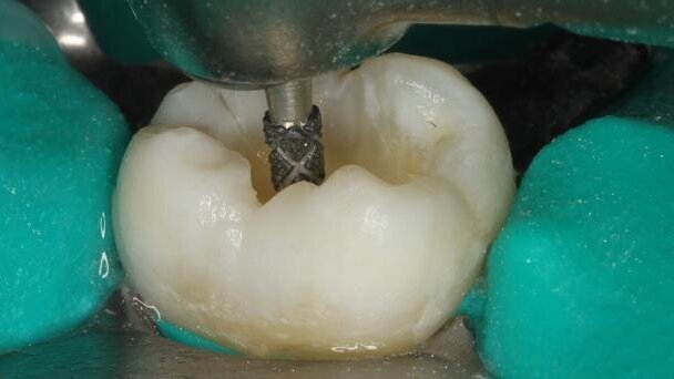 Evolving conservative dentistry