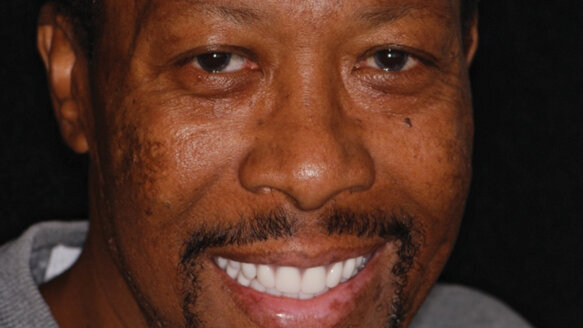 Life-saving treatment includes complete maxillary and mandibular dentures