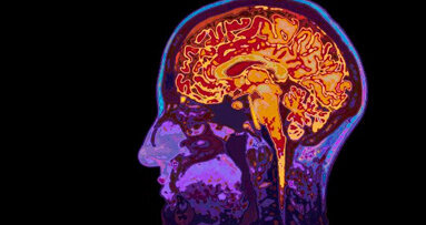 Scoperto un legame tra batteri orali, microemorragie cerebrali e ictus