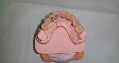 Alternatywna metoda wzajemnej stabilizacji transferów przy wykonywaniu wycisków