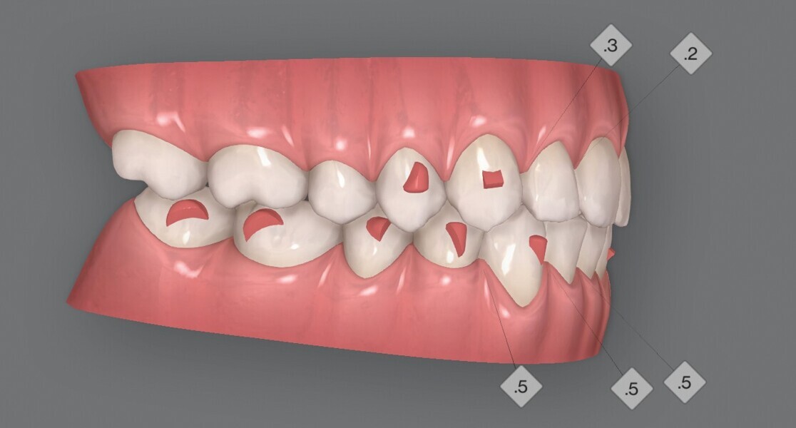 Fig. 4d : Premier résultat prévu par simulation ClinCheck.