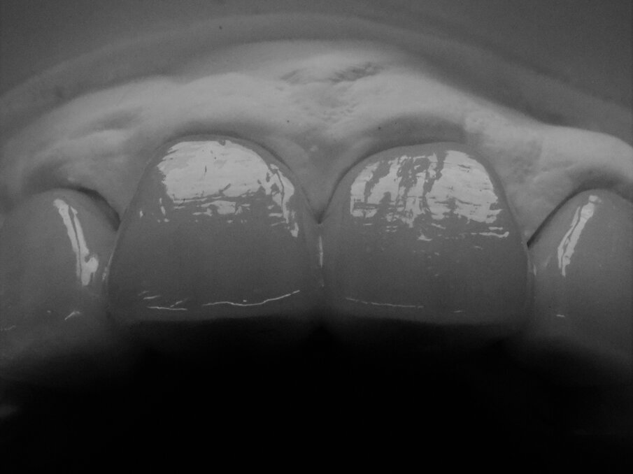 Figg. 3-5 - Stessa tecnica di tessitura eseguita su materiali diversi: denti in ceramica e in resina.