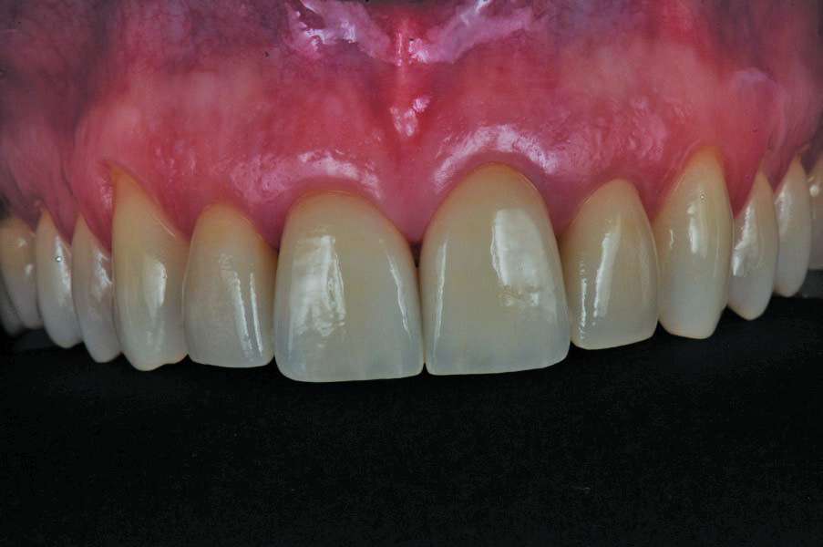 Fig. 7: Temporary in the mouth.