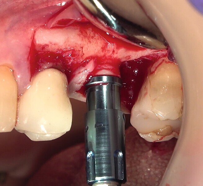 Fig. 39 : Pose de l’implant deux pièces en céramique au niveau tissulaire. 