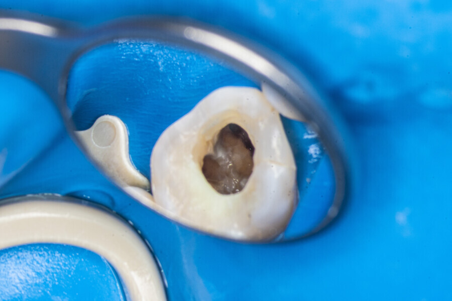 Fig. 20: The MB1 canal, isthmus and MB2 canal.