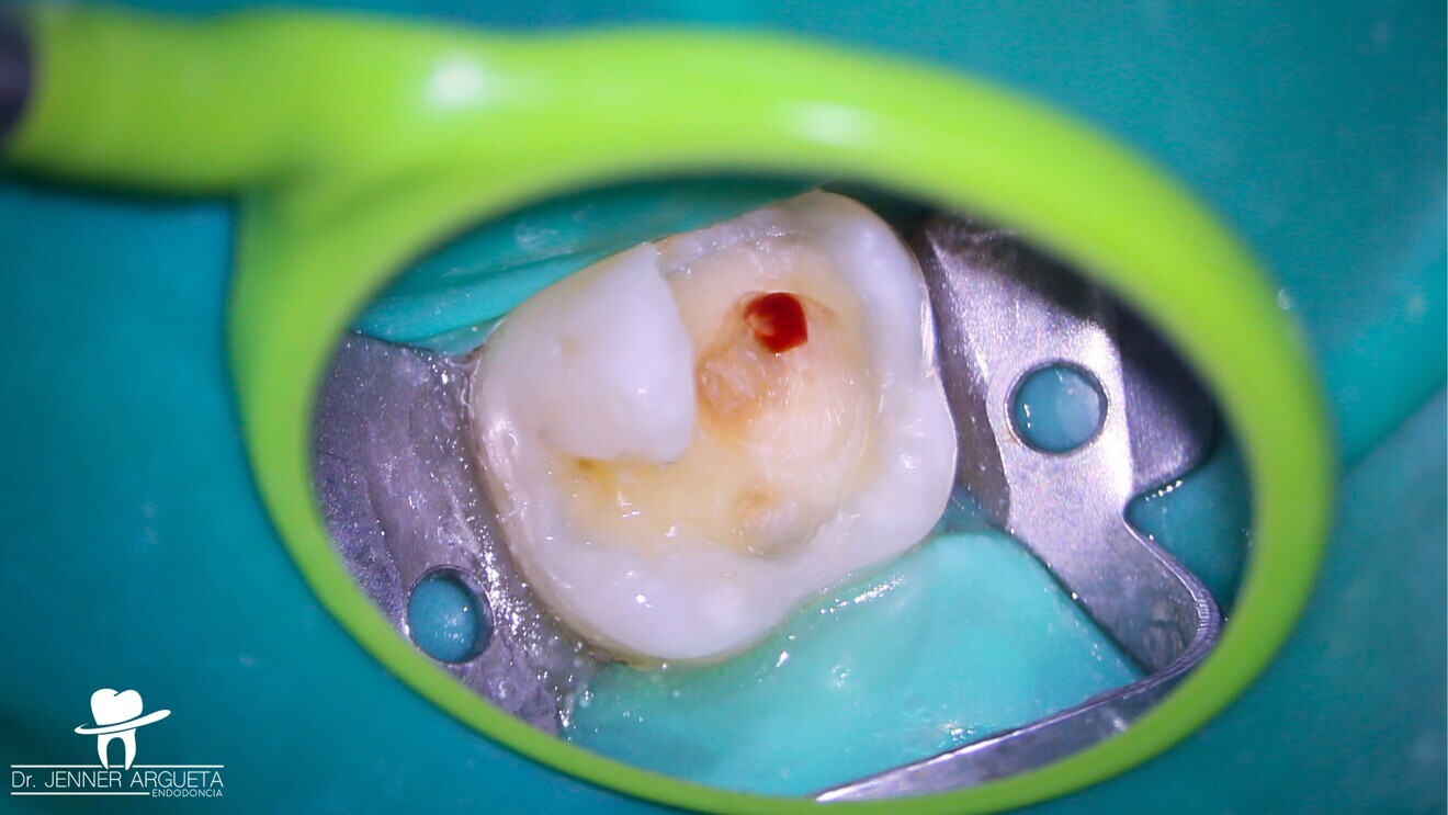 Fig. 3: Pulp exposure at the level of the cavity preparation floor with minimum haemorrhaging that was easy to stop.