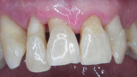 Indagine retrospettiva di follow-up a dieci anni dalla diagnosi e dal trattamento di parodontiti croniche e aggressive