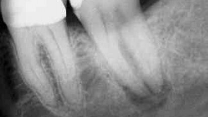 Un suivi de huit ans d’une réimplantation intentionnelle parfaitement réussie