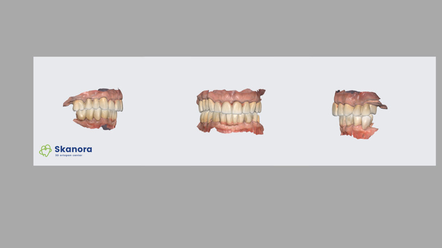 Slika 5a intraoralni sken gotovog ZR mosta (dr Dejan Stajčić)