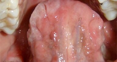 Prevalencia de manifestaciones orales de sífilis en un hospital Salta