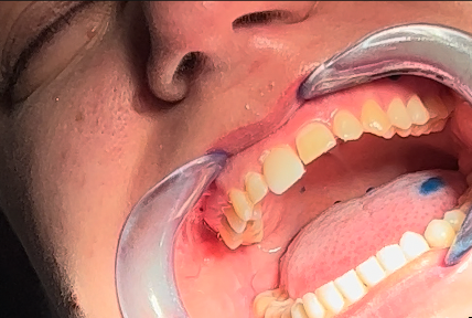 Fig 16 - Prova delle faccette in Irix Max (DWS) stampate in 3D con DFAB.