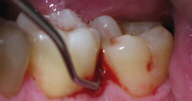 La terapia parodontale non chirurgica mediante laser: studio microbiologico