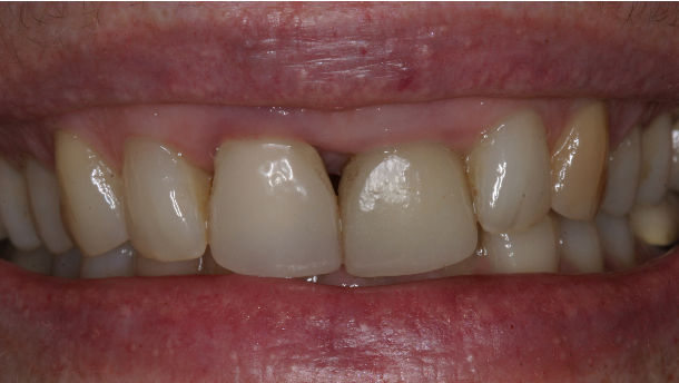 Gestione estetica degli incisivi centrali mascellari adiacenti