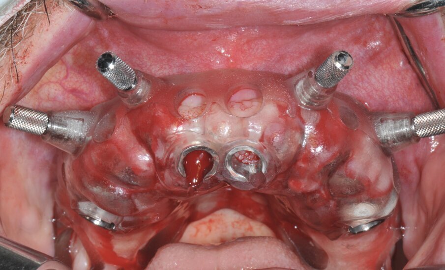 Fig.  3b_Dima chirurgica per l’inserimento degli impianti.