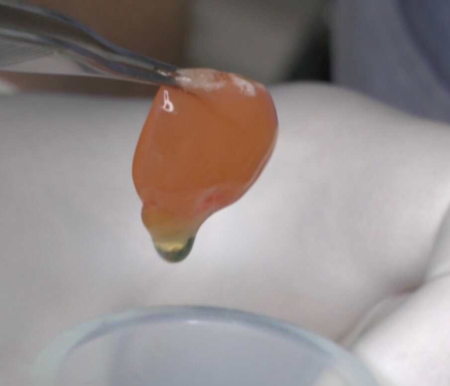 Fig. 11_Preparazione della membrana di PRP ricavata dal prelievo ematico del paziente.