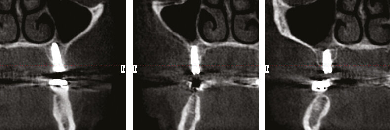 Figs.18-20: CT slices to confirm proper placement. 