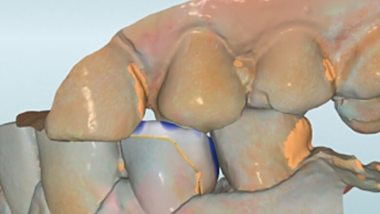 Fig. 7. Durante el diseño de la restauración se respetaron los grosores de capa mínimos.
