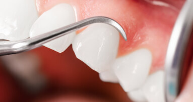 IQWiG: Systematische Behandlung von Parodontopathien