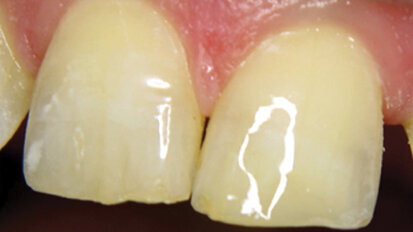 No-flow flowables for ‘Beautifil’ restorations No-flow flowables for ‘Beautifil’ restorations