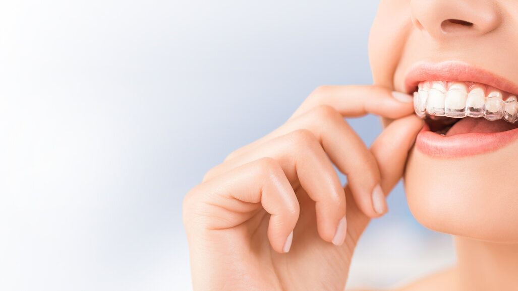 Allineatori in Terapia Ortodontica: Vantaggi e Svantaggi