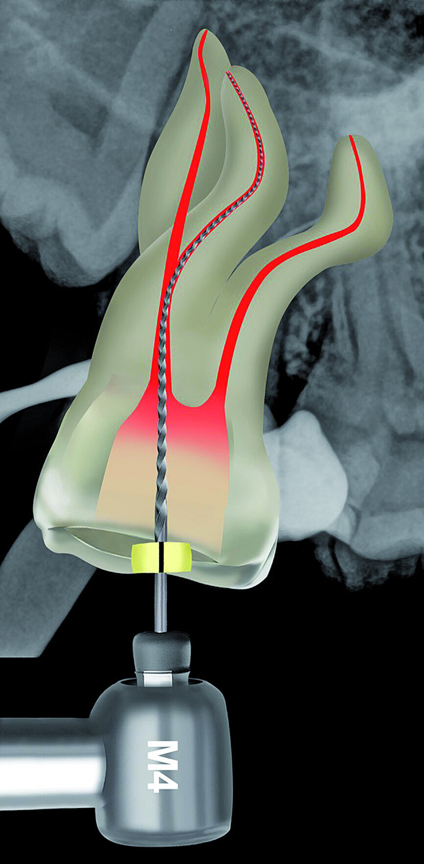 Fig. 21: A size 08 K-File in the M4 reciprocating handpiece was used to initiate the preparation of a reproducible micro glide path.
