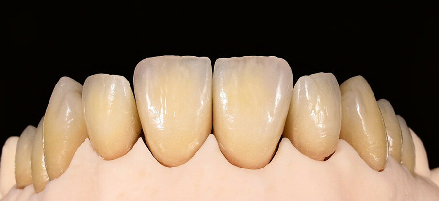 Fig. 15: The final restoration (IPS d.SIGN) after the second orrective firing cycle