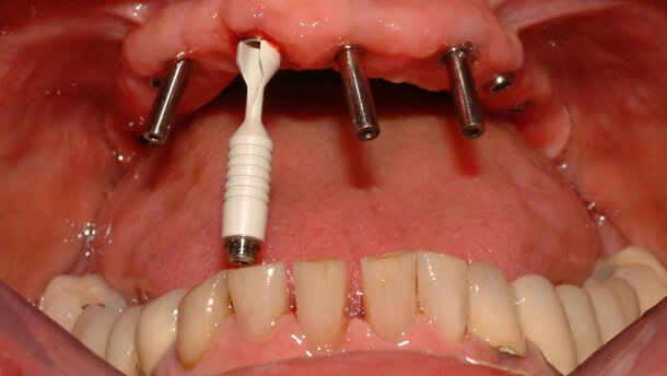 Riabilitazione mascellare full-arch  con strutture avvitate ATLANTIS ISUS  in un caso complesso dal punto di vista estetico