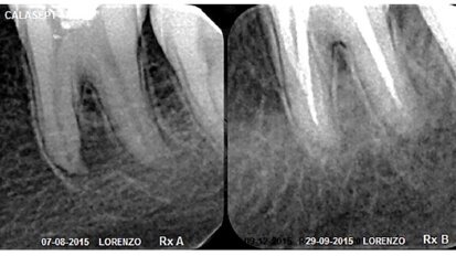 Tratamiento de procesos periapicales con hidróxido de calcio en alta concentración