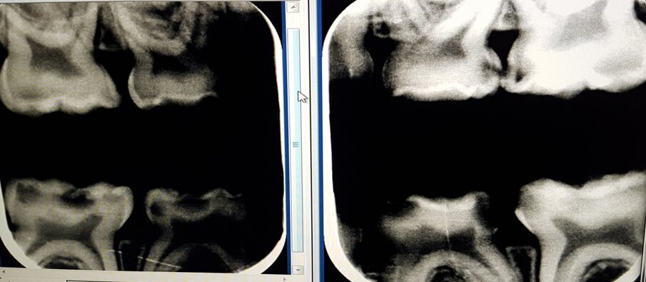 Afbeelding 6c. Multi-cariës bij intake.