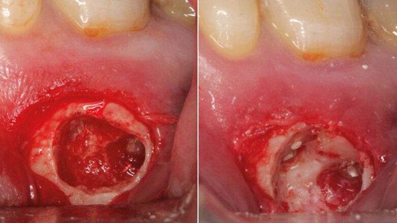 New perspectives in periapical surgery: Hemostasis