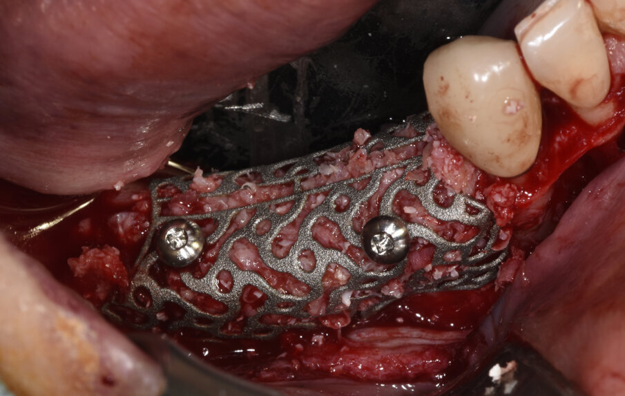 Figg. 4a, 4b_Fotografia che mostra la griglia sterile prima dell’inserimento nella sede da ricostruire. Visione intra-operatoria della griglia Y-Xoss® riempita con un mix di osso autologo particolato prelevato dal ramo mandibolare e osso eterologo in rapporto 1:1, fissata mediante 2 viti in titanio di 1.4 mm di diametro.