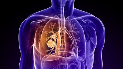 Atemtest soll Krebserkrankung erkennen