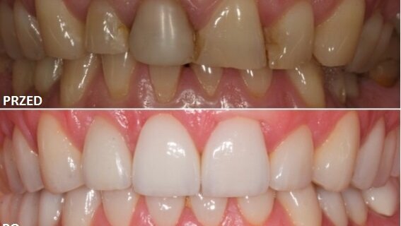 Regeneracja kości i pokrycie recesji w leczeniu estetyczno-implantologicznym