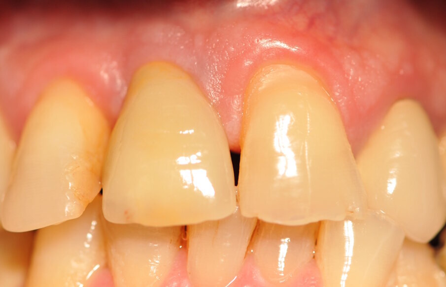 Fig. 11_Corona definitiva a 1 mese dalla cementazione.