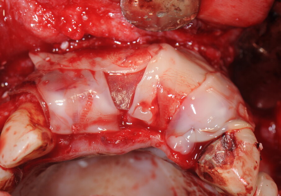 Fig. 11 - Copertura con membrane in L-PRF.
