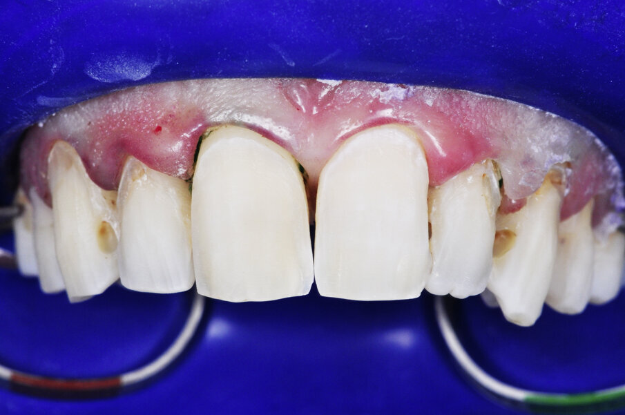 Fig. 18: Original preparation 9 years ago