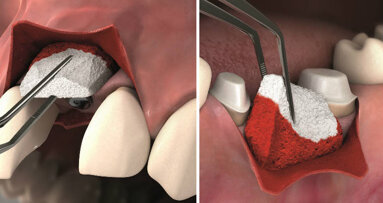 Geistlich Fibro-Gide®: la scelta dei clinici