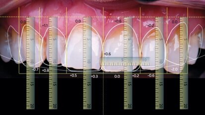 Cyfrowe projektowanie uśmiechu, przeniesienie projektu na model roboczy – część 2