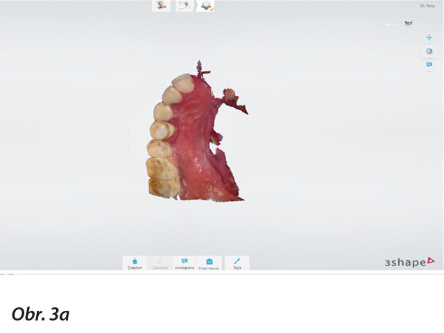 Intraorální digitální otisk pravé strany maxily.